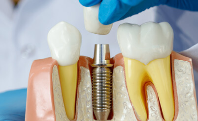 img-Dental-Implants