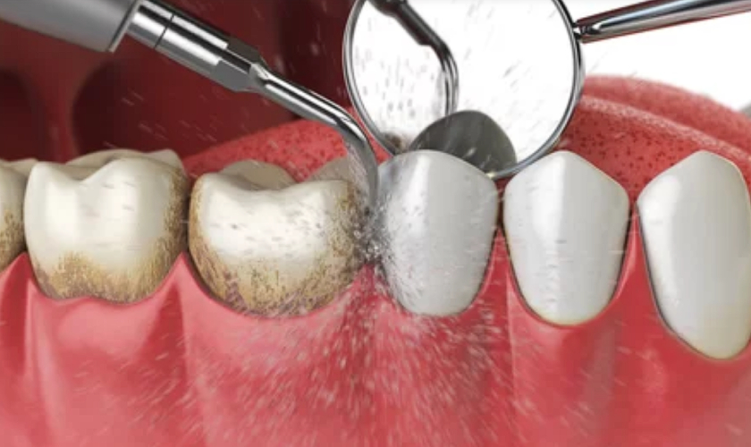 Teeth Cleaning - Cottleville Smiles